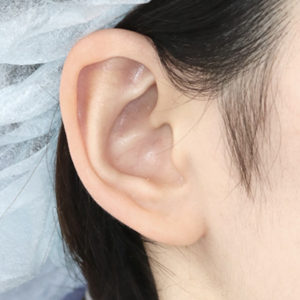 「鼻孔縁下降術（耳の傷痕）」　新宿ラクル美容外科クリニック　山本厚志　２０代女性　手術後２ヶ月目　１２月２０日