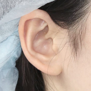 「鼻孔縁下降術（耳の傷痕）」　新宿ラクル美容外科クリニック　山本厚志　２０代女性　手術後３ヶ月目　１２月２９日