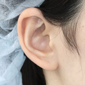 「鼻孔縁下降術（耳の傷痕）」　新宿ラクル美容外科クリニック　山本厚志　２０代女性　手術後６ヶ月目　３月１１日