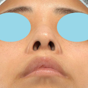「鼻孔縁下降術」　新宿ラクル美容外科クリニック　山本厚志　２０代女性　手術前　１２月１７日