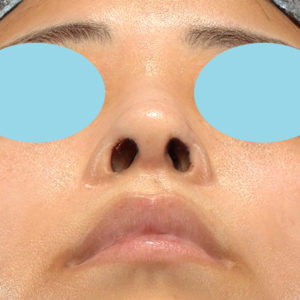 「鼻孔縁下降術」　新宿ラクル美容外科クリニック　山本厚志　２０代女性　手術直後　１２月１７日