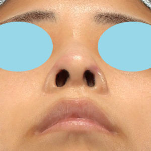 「鼻孔縁下降術」　新宿ラクル美容外科クリニック　山本厚志　２０代女性　手術後１週間目　１２月１７日