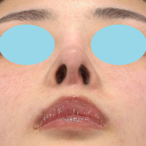 「鼻中隔延長(鼻中隔軟骨)＋耳介軟骨移植 修正＋鼻尖形成 修正＋猫手術＋鼻プロテーゼ入れ替え」　新宿ラクル美容外科クリニック　３０代女性　手術後１２ヶ月目　５月１８日