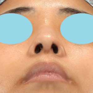 「鼻孔縁下降術」　新宿ラクル美容外科クリニック　山本厚志　２０代女性　手術後２ヶ月目　１２月１７日