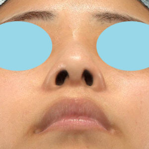 「鼻孔縁下降術」　新宿ラクル美容外科クリニック　山本厚志　２０代女性　手術後３ヶ月目　１２月３１日