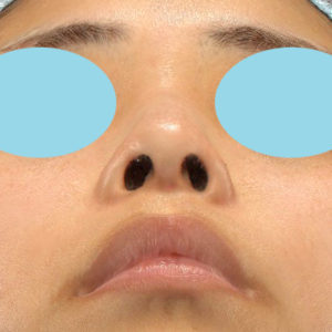 「鼻孔縁下降術」　新宿ラクル美容外科クリニック　山本厚志　２０代女性　手術後６ヶ月目　３月１７日