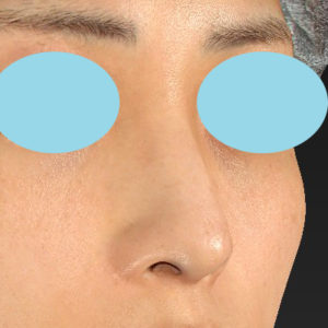 「鼻孔縁下降術」　新宿ラクル美容外科クリニック　山本厚志　２０代女性　手術前　１２月１７日