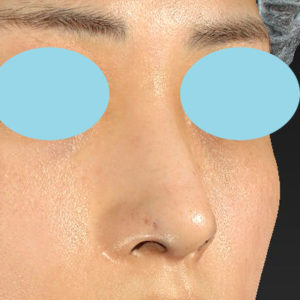 「鼻孔縁下降術」　新宿ラクル美容外科クリニック　山本厚志　２０代女性　手術直後　１２月１７日