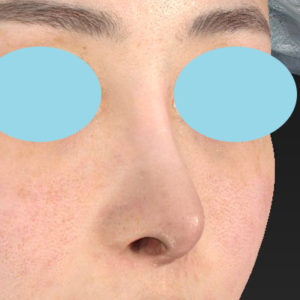 「鼻中隔延長(鼻中隔軟骨)＋耳介軟骨移植 修正＋鼻尖形成 修正＋猫手術＋鼻プロテーゼ入れ替え」　新宿ラクル美容外科クリニック　３０代女性　手術後１２ヶ月目　５月１８日