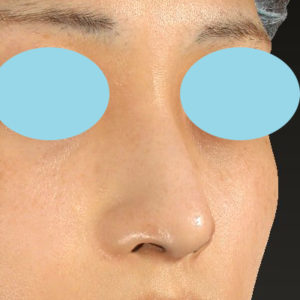 「鼻孔縁下降術」　新宿ラクル美容外科クリニック　山本厚志　２０代女性　手術後１ヶ月目　１２月１７日