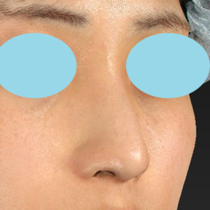 「鼻孔縁下降術」　新宿ラクル美容外科クリニック　山本厚志　２０代女性　手術後３ヶ月目　１２月３１日