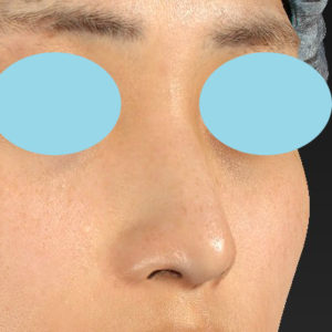 「鼻孔縁下降術」　新宿ラクル美容外科クリニック　山本厚志　２０代女性　手術後６ヶ月目　３月１７日