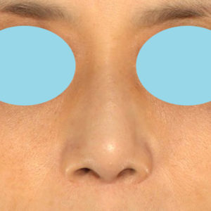 新宿ラクル美容外科クリニック　山本厚志　「テスリフトノーズ」　手術後１２ヶ月目　８月２５日