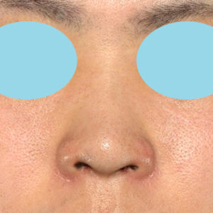 「鼻孔縁下降術」　新宿ラクル美容外科クリニック　山本厚志　２０代男性　手術後２ヶ月目　１月８日