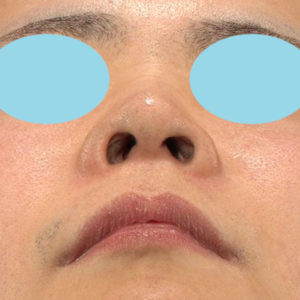 「鼻孔縁下降術」　新宿ラクル美容外科クリニック　山本厚志　２０代男性　手術前　１月８日