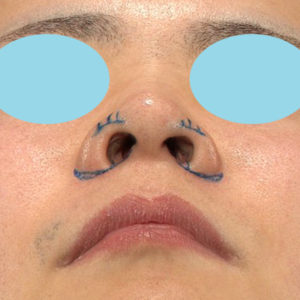 「鼻孔縁下降術」　新宿ラクル美容外科クリニック　山本厚志　２０代男性　デザイン　１月８日