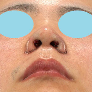 「鼻孔縁下降術」　新宿ラクル美容外科クリニック　山本厚志　２０代男性　手術直後　１月８日