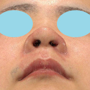 「鼻孔縁下降術」　新宿ラクル美容外科クリニック　山本厚志　２０代男性　手術後１週間目　１月８日