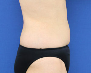 新宿ラクル美容外科クリニック　山本厚志　「ライポライフ脂肪吸引（腹部全体＋腰）」　手術後１２ヶ月目　６月２９日