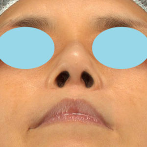 新宿ラクル美容外科クリニック　山本厚志　「テスリフトノーズ」　手術後１２ヶ月目　８月２５日