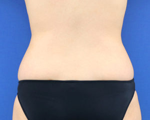 新宿ラクル美容外科クリニック　山本厚志　「ライポライフ脂肪吸引（腹部全体＋腰）」　手術後１２ヶ月目　６月２９日