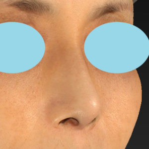 新宿ラクル美容外科クリニック　山本厚志　「テスリフトノーズ」　手術後１２ヶ月目　８月２５日