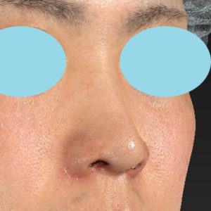 「鼻孔縁下降術」　新宿ラクル美容外科クリニック　山本厚志　２０代男性　手術後１ヶ月目　１月８日