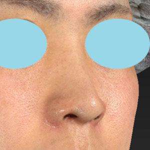 「鼻孔縁下降術」　新宿ラクル美容外科クリニック　山本厚志　２０代男性　手術後２ヶ月目　１月８日