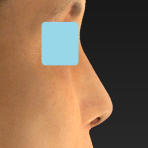 新宿ラクル美容外科クリニック　山本厚志　「テスリフトノーズ」　手術後１２ヶ月目　８月２５日