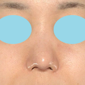 「鼻中隔延長＋耳介軟骨移植＋鼻尖形成」　新宿ラクル美容外科クリニック　２０代女性　手術後１ヶ月目　２月９日