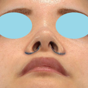 新宿ラクル美容外科クリニック　山本厚志　「小鼻縮小+α法」　デザイン　２月１日