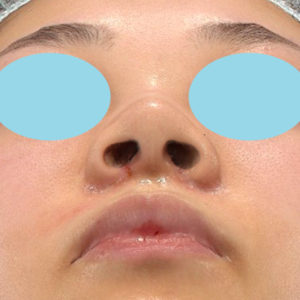 新宿ラクル美容外科クリニック　山本厚志　「小鼻縮小+α法」　手術後１週間目　２月１日