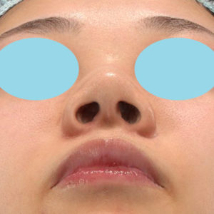 新宿ラクル美容外科クリニック　山本厚志　「小鼻縮小+α法」　手術後１ヶ月目　２月１日