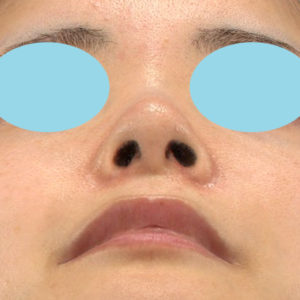 新宿ラクル美容外科クリニック　山本厚志　「小鼻縮小+α法」　手術後２ヶ月目　３月６日