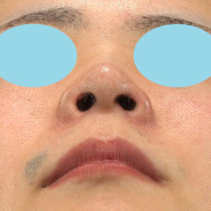 「鼻孔縁下降術、小鼻縮小＋α法」　新宿ラクル美容外科クリニック　山本厚志　２０代男性　手術後６ヶ月目　６月２２日