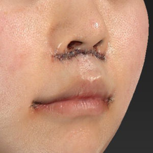 新宿ラクル美容外科クリニック　山本厚志　「猫手術（鼻唇角形成術）+ 貴族手術（鼻翼基部プロテーゼ）+ 口角挙上（スマイルリフト）+ 人中短縮術（リップリフト）」　手術直後　２月１３日