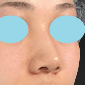 新宿ラクル美容外科クリニック　山本厚志　「小鼻縮小+α法」　手術後１ヶ月目　２月１日