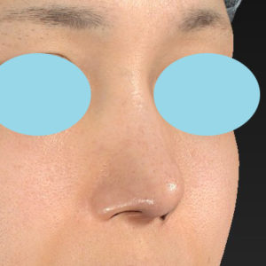 「鼻中隔延長＋耳介軟骨移植＋鼻尖形成」　新宿ラクル美容外科クリニック　２０代女性　手術後２ヶ月目　２月９日