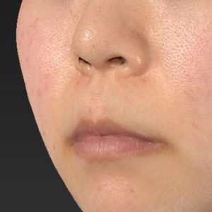 新宿ラクル美容外科クリニック　山本厚志　「猫手術（鼻唇角形成術）+ 貴族手術（鼻翼基部プロテーゼ）+ 口角挙上（スマイルリフト）+ 人中短縮術（リップリフト）」　手術前　２月１３日