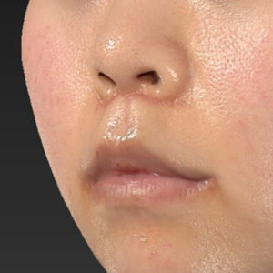新宿ラクル美容外科クリニック　山本厚志　「猫手術（鼻唇角形成術）+ 貴族手術（鼻翼基部プロテーゼ）+ 口角挙上（スマイルリフト）+ 人中短縮術（リップリフト）」　手術後１ヶ月目　２月１３日