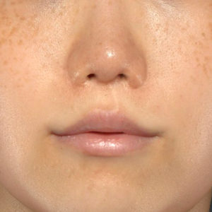 新宿ラクル美容外科クリニック　山本厚志　「人中短縮術（リップリフト）＋口角挙上（スマイルリップ）」　手術後１２ヶ月目　８月２６日