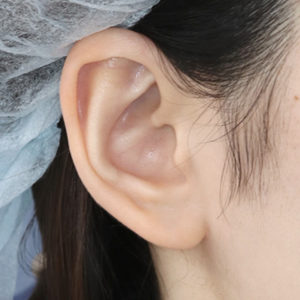 「鼻孔縁下降術（耳の傷痕）」　新宿ラクル美容外科クリニック　山本厚志　２０代女性　手術後１２ヶ月目　９月５日