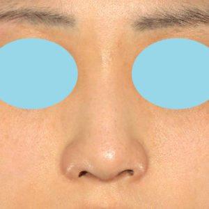 「鼻孔縁下降術」　新宿ラクル美容外科クリニック　山本厚志　２０代女性　手術後１２ヶ月目　９月２１日