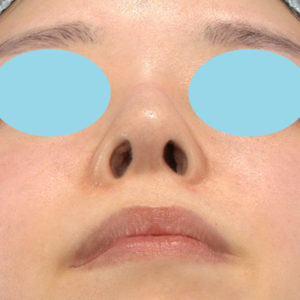 「鼻孔縁下降術」　新宿ラクル美容外科クリニック　山本厚志　２０代女性　手術前　３月２４日