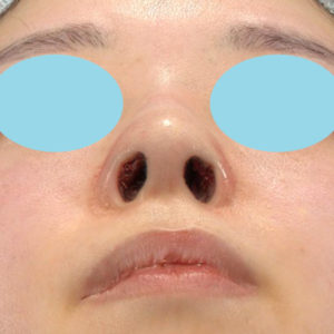 「鼻孔縁下降術」　新宿ラクル美容外科クリニック　山本厚志　２０代女性　手術直後　３月２４日