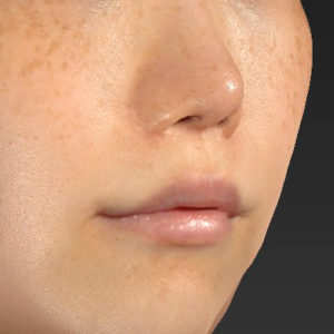 新宿ラクル美容外科クリニック　山本厚志　「人中短縮術（リップリフト）＋口角挙上（スマイルリップ）」　手術後１２ヶ月目　８月２６日