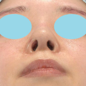「鼻孔縁下降術」　新宿ラクル美容外科クリニック　山本厚志　２０代女性　手術後１ヶ月目　３月２４日