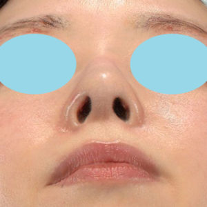 「鼻孔縁下降術」　新宿ラクル美容外科クリニック　山本厚志　２０代女性　手術後２ヶ月目　３月２４日