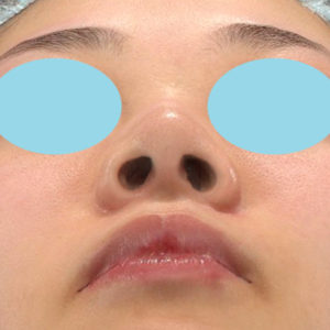 新宿ラクル美容外科クリニック　山本厚志　「小鼻縮小+α法」　手術後３ヶ月目　３月３０日