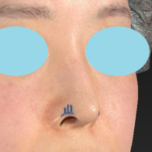 「鼻孔縁下降術」　新宿ラクル美容外科クリニック　山本厚志　２０代女性　デザイン　３月２４日
